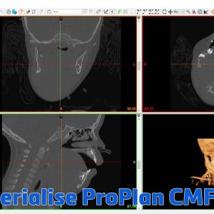 Materialise ProPlan CMF 3.0.1